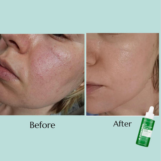 Nineless A-Control 10% Azelaic Acid Serum 30ml